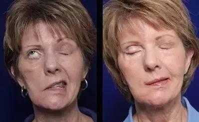 面肌痉挛右眼皮跳北京哪里治疗,眼皮一直抽搐跳动的原因面肌痉挛