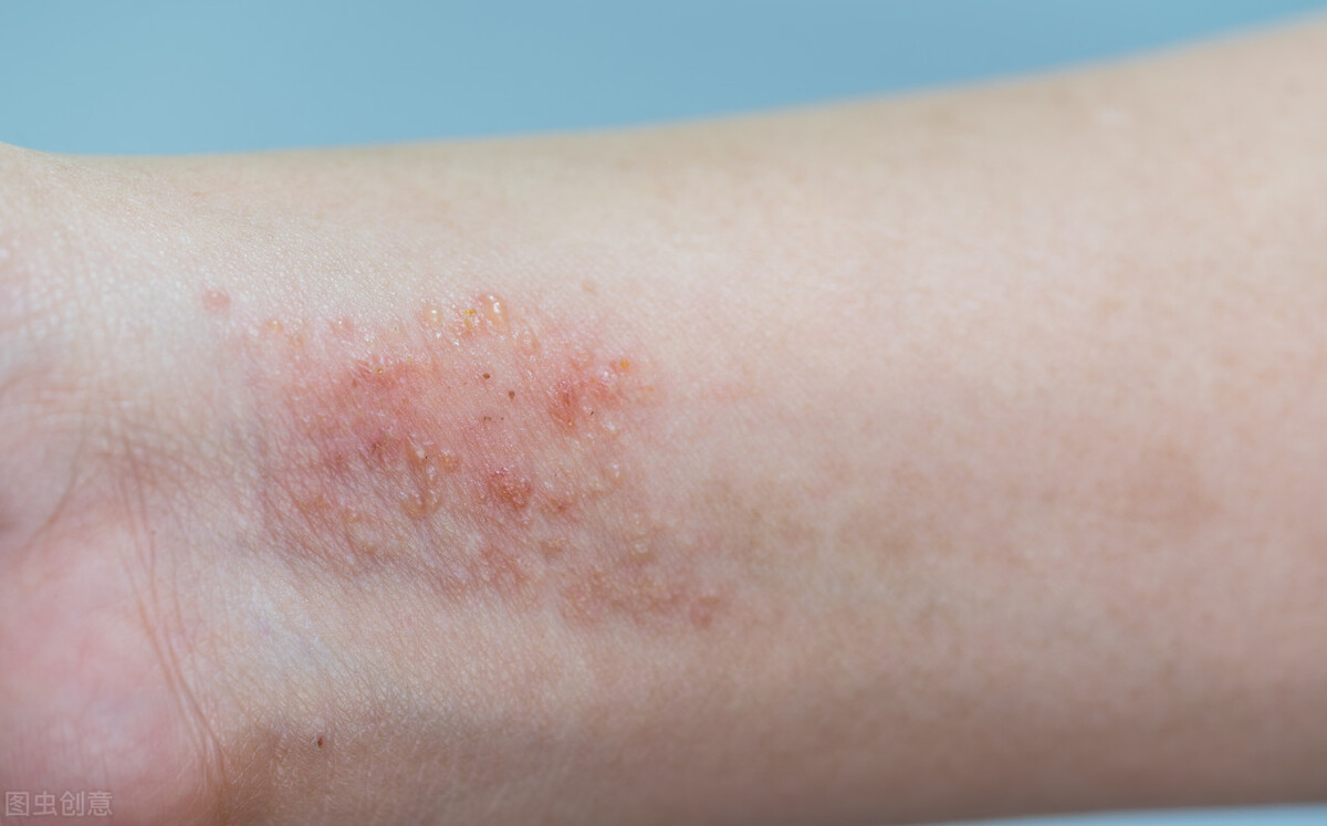 湿疹为什么总是好不了?可能是这个原因