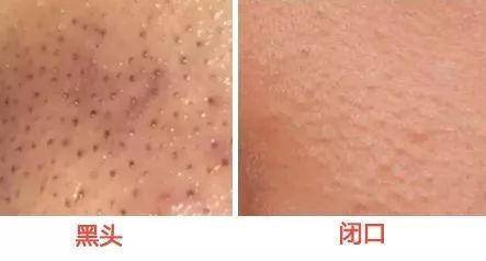 去黑头粉刺简单有效的方法,去黑头粉刺超级治愈