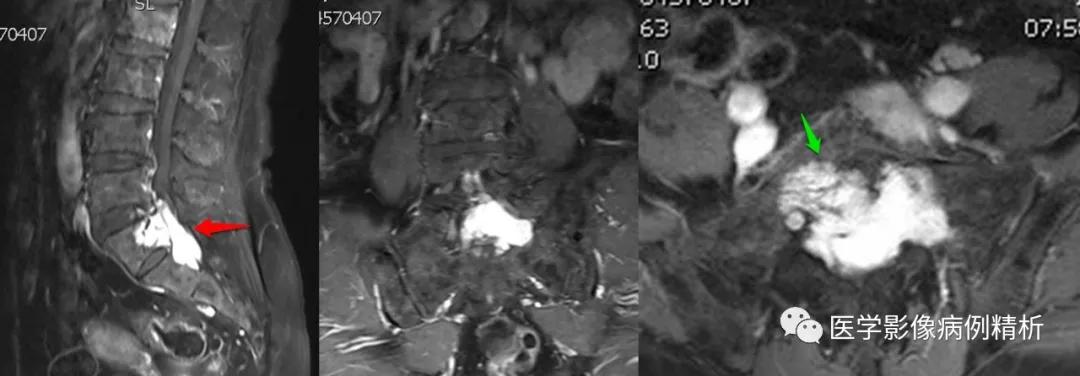 海绵状血管瘤在mri中的影像表现,骶骨处影像显示有血管瘤