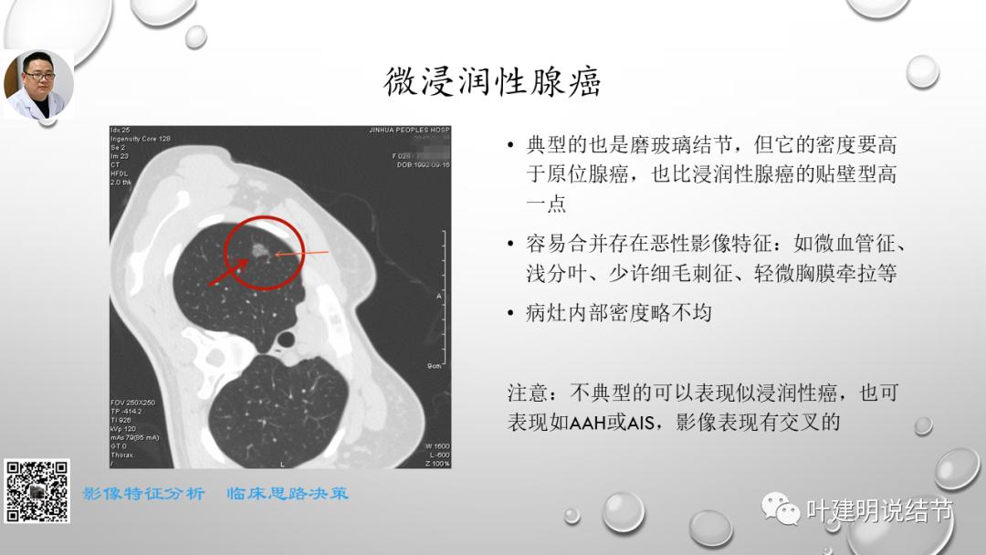 叶建明谈肺实性小结节视频,廖正银教授谈肺结节