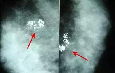 一分钟教你看懂乳腺报告单,乳腺检查报告4b怎么办