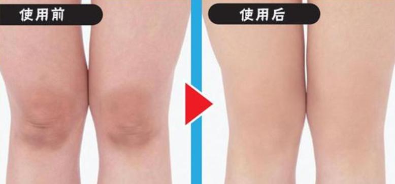 胳膊肘和膝盖黑怎么变白,手臂膝盖处黑要怎么美白