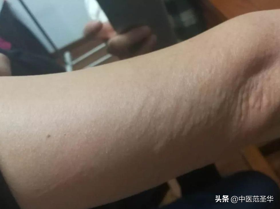 中医治抓痕性皮炎,中医治皮肤抓痕症