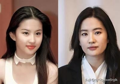 小切口面部提升除皱术,小切口除皱术轻松摆脱皱纹困扰