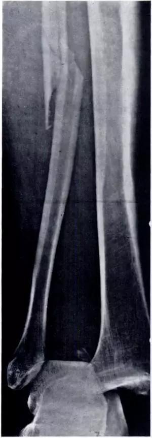 特殊骨折类型,特殊骨折体征