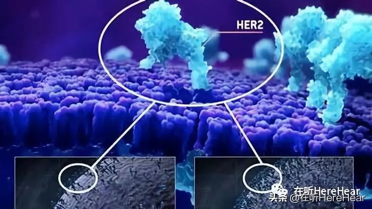 非化疗的乳腺癌新疗法：荷尔蒙疗法/抗HER2靶向药详细介绍