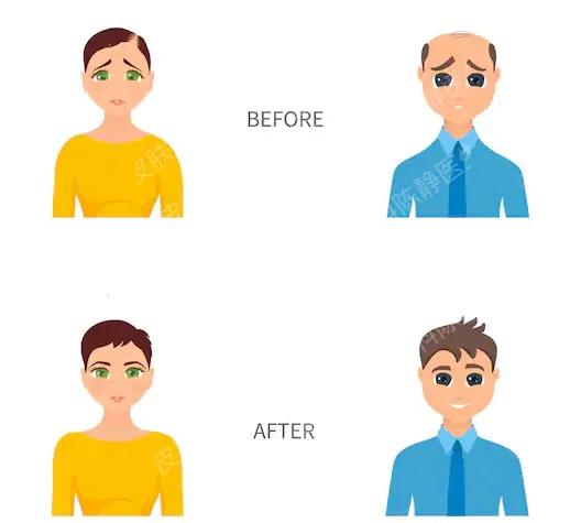 米诺地尔治疗脱发成功案例 (米诺地尔治疗脱发的正确使用方法)