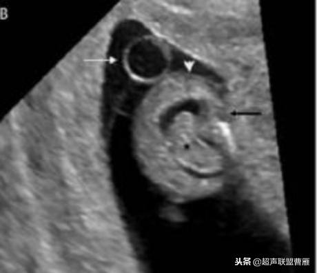 3毫米卵黄囊未见胎芽正常么,40多天的卵黄囊