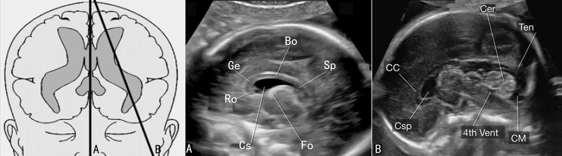 孕期头部彩超查什么,孕期检查胎儿头部有一个地方宽
