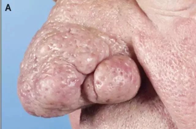 痘痘反反复复教你一招祛痘不再难,为了祛痘曾经你试过哪些方法