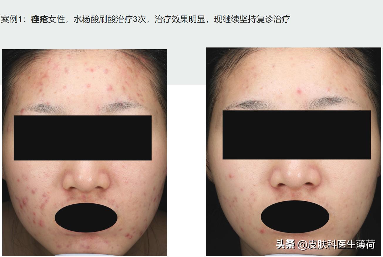 修复痘坑水杨酸果酸哪种好用,刷酸去闭口水杨酸敏感肌