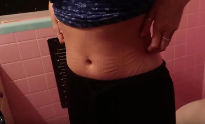 戴束腰子宫下垂,网红束腰导致内脏下垂