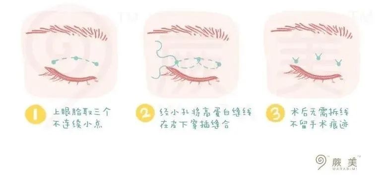 到底该不该全切双眼皮,怎么判断自己该不该割双眼皮
