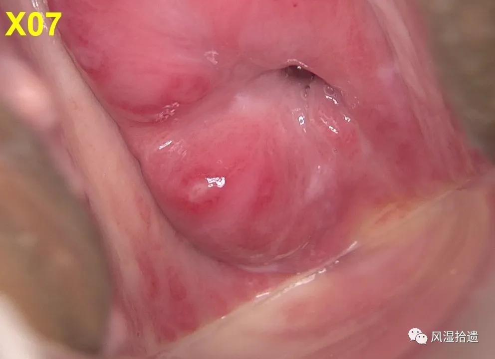 「病例分享」阴道镜和胃镜检查后发现的白塞病