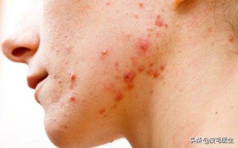 冬天换季干燥脱皮爆痘,冬季干燥泛红脱皮敏感爆痘怎么办