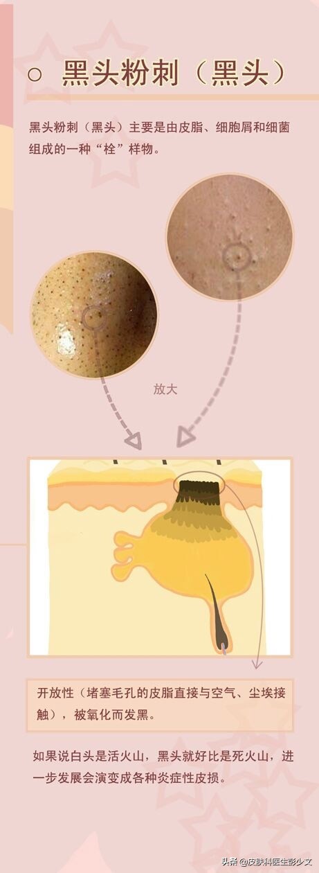 连续十年不停的长痘疮是怎么回事,身上长痘疮怎么治疗