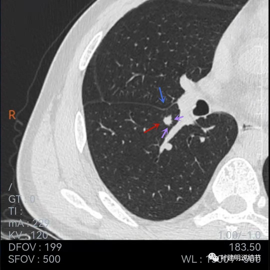 问诊分析:存在了4年的实性结节会不会是肺癌?