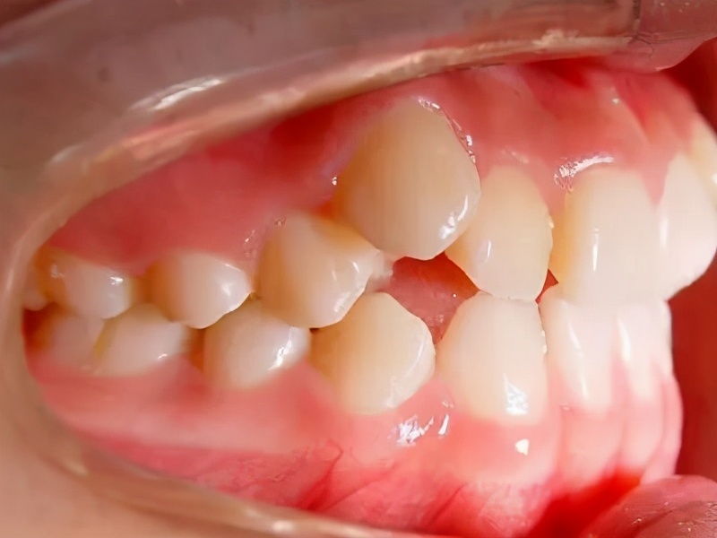 老虎牙怎么矫正,老虎牙矫正的全过程