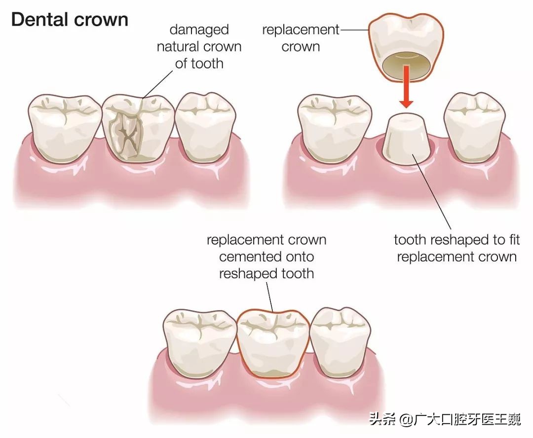 全瓷牙与烤瓷牙哪种好,好的烤瓷牙和便宜的全瓷牙的区别