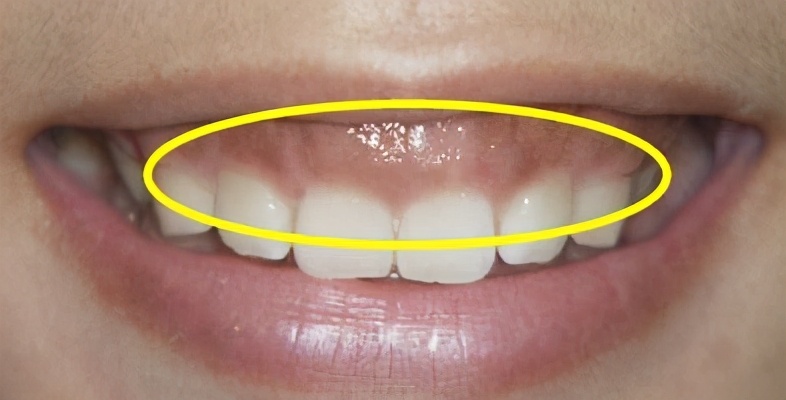 牙龈萎缩和气血不足有关系吗,牙龈的颜色区别方法图解