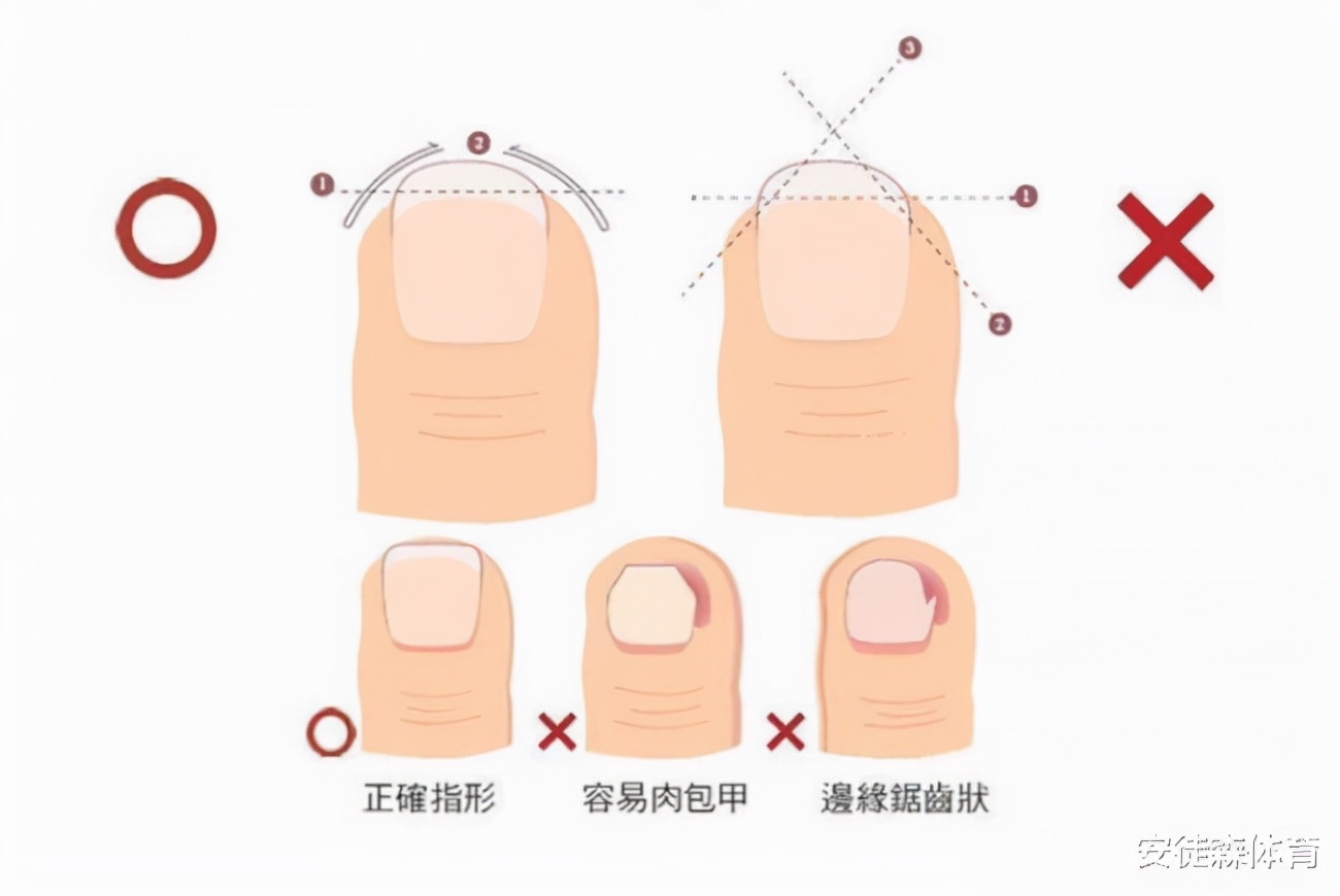 怎样避免跑步黑指甲,跑步时如何保护指甲