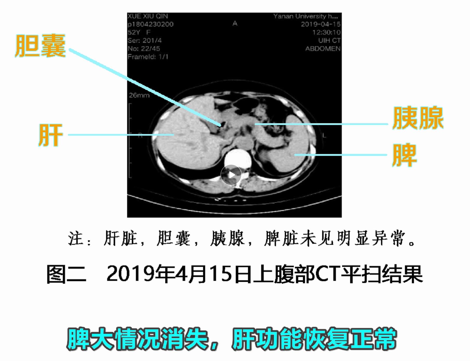 病毒性早期肝硬化干扰素能逆转吗,干扰素可以逆转肝硬化吗
