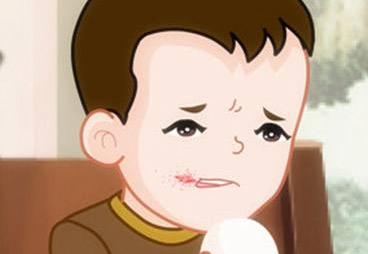 烂嘴角最快的解决办法,吃腊肉上火烂嘴角是什么原理