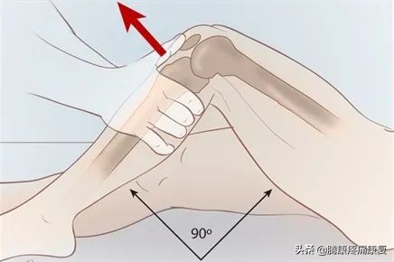 前交叉韧带断裂半月板后角撕裂,左膝前交叉韧带部分撕裂怎么办