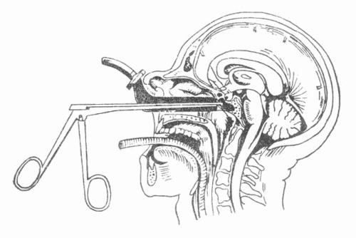 得了垂体瘤该怎么治疗?伽玛刀还是手术切除?