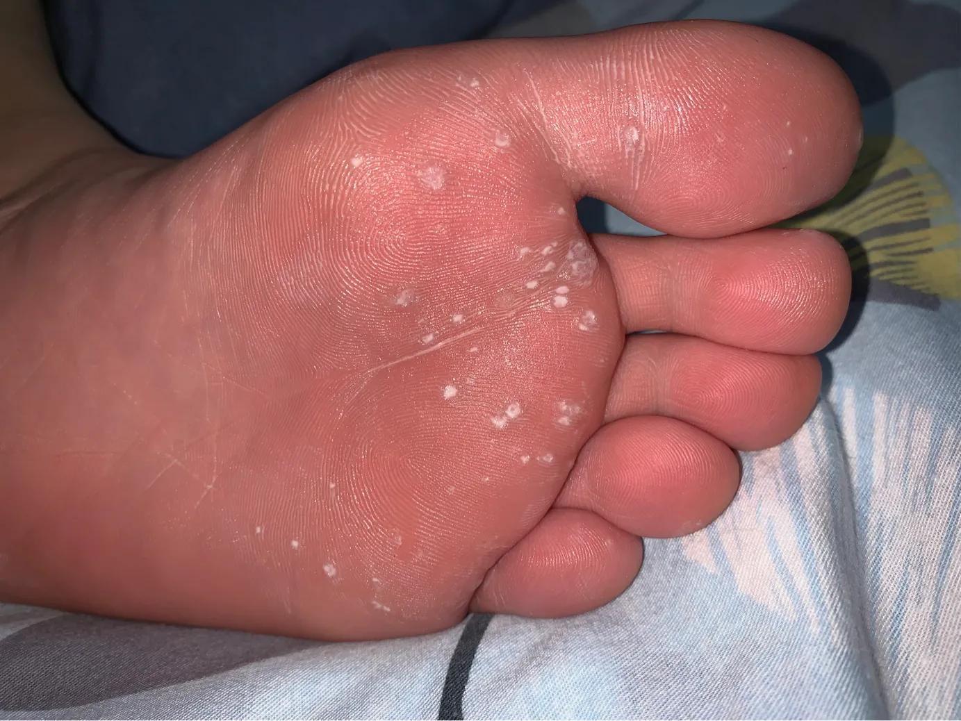 10岁女孩脚底跖疣怎么治疗,少女脚底跖疣