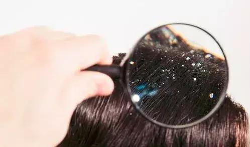 头皮痒头屑多是脂溢性皮炎,头皮油又痒头皮屑多是怎么回事