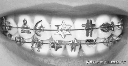 矫正牙齿不拔牙出现龅牙怎么办,40岁矫正牙齿拔牙不拔牙有区别吗