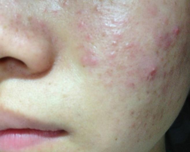 床上有螨虫导致皮肤瘙痒怎么止痒,螨虫会引起皮肤瘙痒晒太阳可以吗