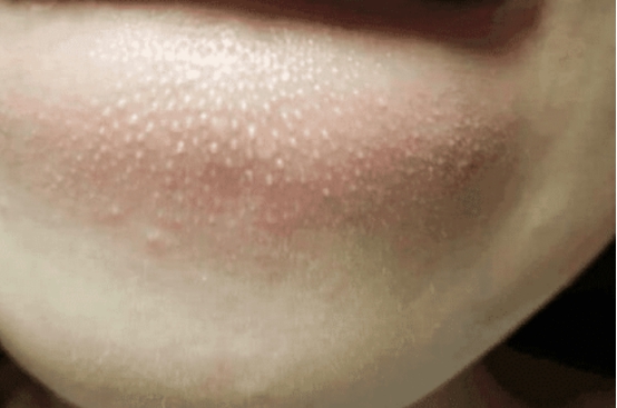 一抿嘴就有白色颗粒,嘴下的小颗粒怎么去除