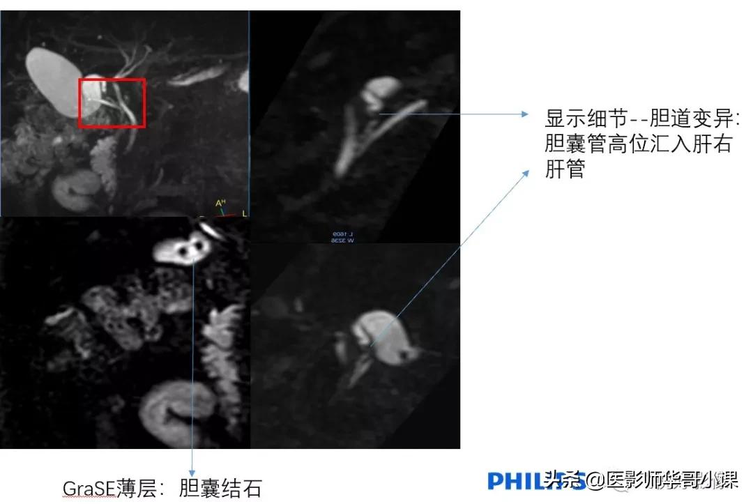 「飞利浦磁共振技术」胆道系统胆胰管水成像之3D_MRCP_BH