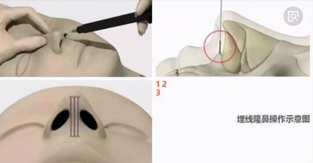 什么是线雕哪些医院能做,哪些人不能做线雕鼻