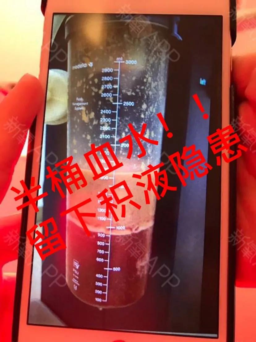 吸脂后腰部有积液抽一次,腰部吸脂一个月还有积液