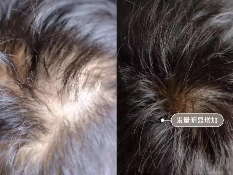 发际线高头发稀疏掉头发怎么拯救,发际线后移的头发还能长出来么
