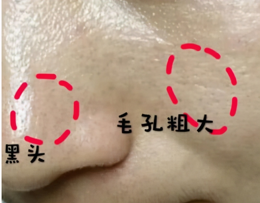 混干皮瑕疵皮毛孔粗大博主推荐,油皮瑕疵皮毛孔粗大