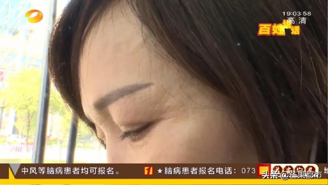 医生推荐去除法令纹,长沙法令纹除皱