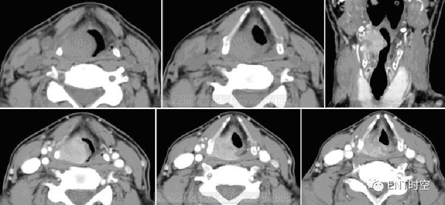 主任读片会：六大「喉部典型病例」大饱眼福