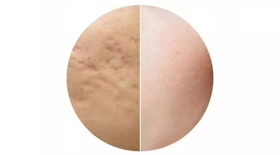 手把手教你正确挤痘不留坑,挤痘有个坑怎么补救