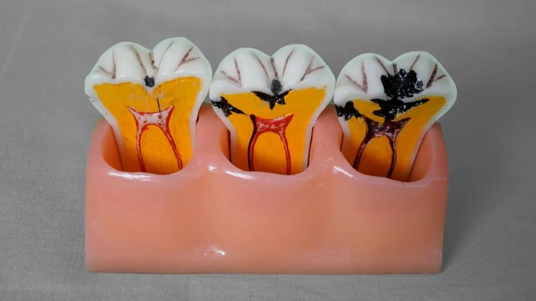 根管治疗是不是就是杀死神经,根管第一次封药是杀神经吗