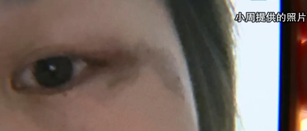 服装导购隔壁点痣，付完150直接注射液体！女子怒：不闭眼就被搞瞎