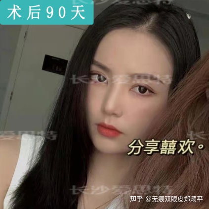 可以只开眼角不割双眼皮吗,双眼皮到底要不要开眼角