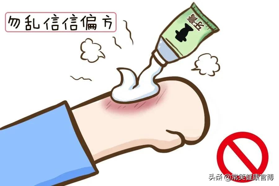 烧烫伤膏治疗一般的烫伤多久会好,缓解烫伤恢复阶段疼痛的办法