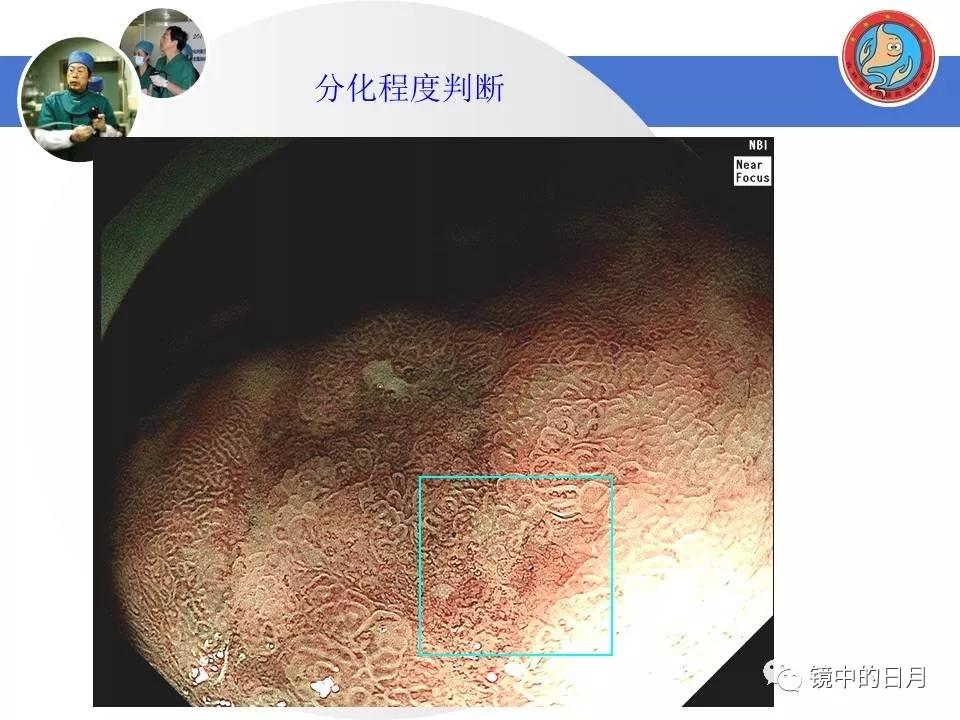 低分化胃癌早期时候做内镜手术吗,早期胃癌内镜手术后追加外科手术