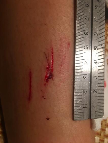 酒店浴室玻璃爆裂女孩被割伤,玻璃门爆裂后扎伤如何处理