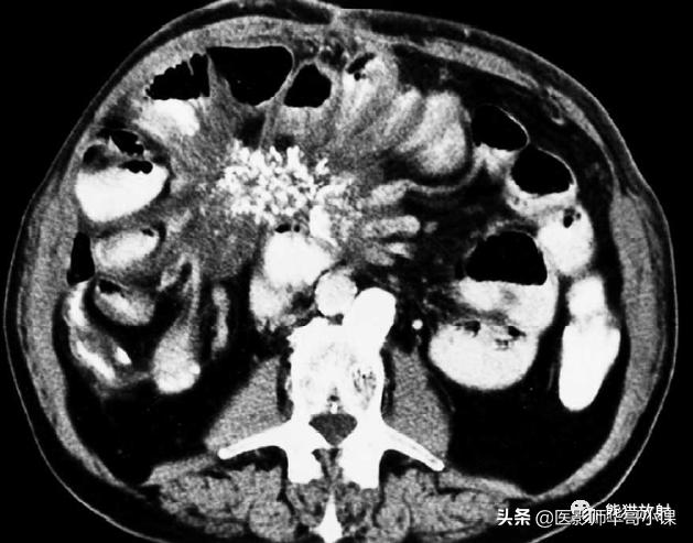 「精品课件」11种腹膜感染/炎症性病变的影像学表现